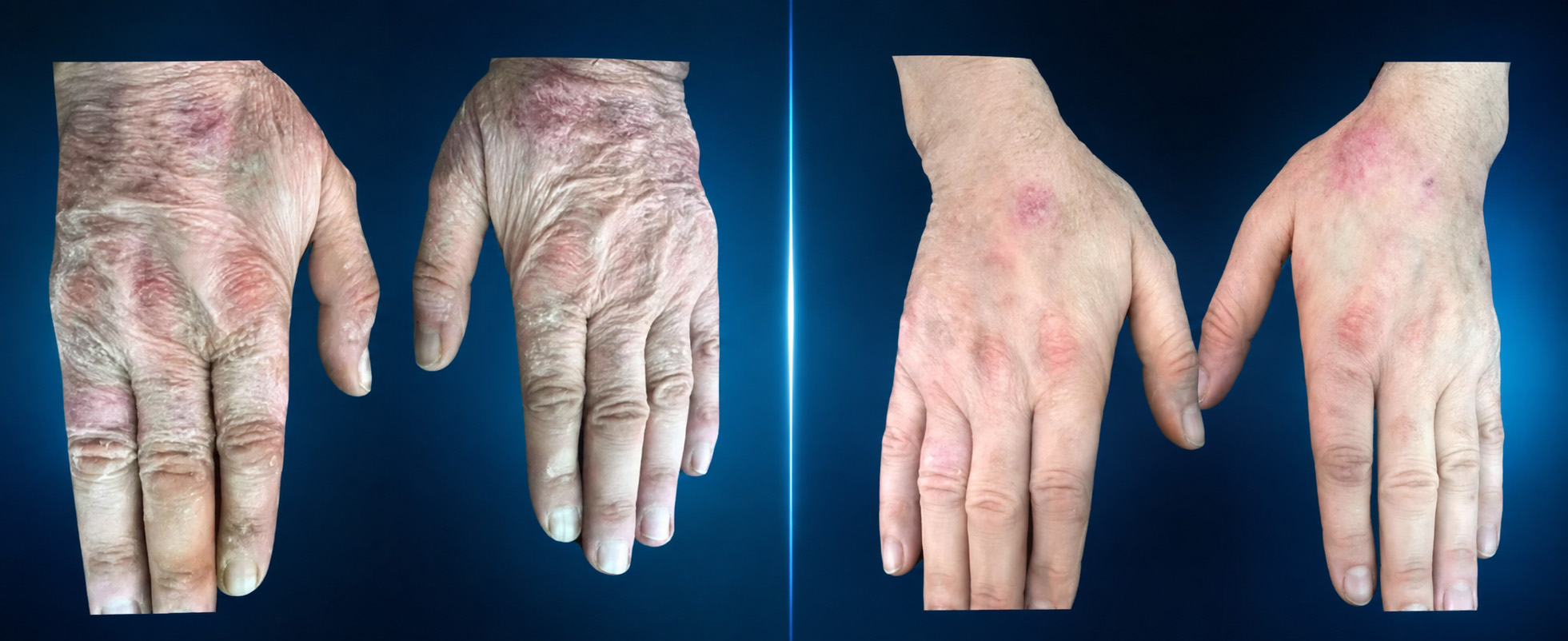 Before-and-after clinical example of patient hands treated by Mauro Tiziani with Myomodulation