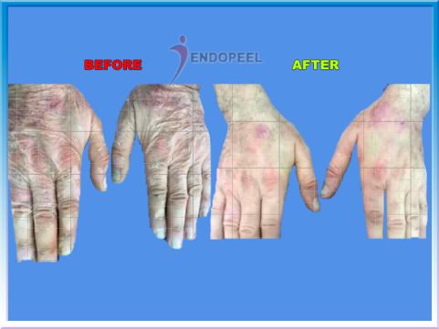old-hands-endopeel.